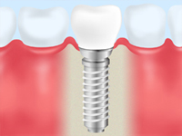 周りの歯に負担をかけないインプラント