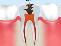 歯の根の治療で歯を残す