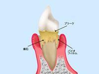 歯周病にもご注意を！