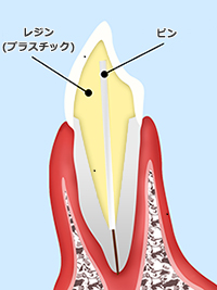 レジンコア